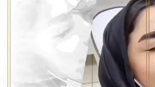 مزوتراپی ابرو