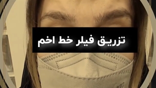 فیلر خط اخم