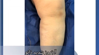 آرتروز شدید زانو