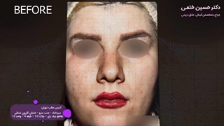 نمونه ای دیگر از جراحی بینی