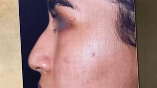 ⚜️نمونه جراحی بینی