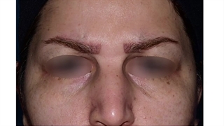 لیفت پیشانی به روش آندوسکوپیک