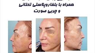 لیفت کامل صورت و گردن