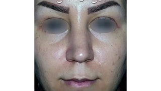 عمل رینوپلاستی اولیه