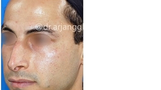 جراحی زیبایی بینی (رینوپلاستی) در آقایان _______