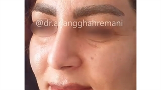 رینوپلاستی اولیه در بانوان