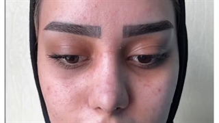 نمونه جراحی زیبایی بینی
