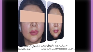 تزریق چربی