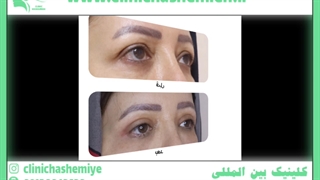 جراحی پلک