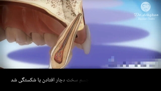 کلینیک دندان پزشکی دکتر دهقان : با شکستگی دندان چه کنیم؟