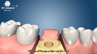 کلینیک دکتر وحید دهقان : ایمپلنت با جراحی