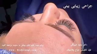 فیلم عمل بینی طبیعی در کلینیک دکتر سعید شیرنگی