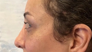 جراحی لیفت پیشانی اندوسکوپیک وبلفاروپلاستی