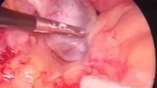 جراحی کیست اندومتریوما