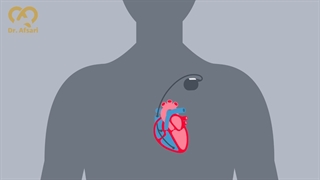 Icd✅باطری قلب