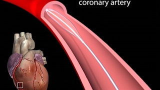بالن آنژیوپلاستی ..