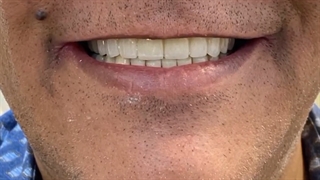 بازسازی فک بالای بیمار با روکش های مبتنی بر ایمپلنت | دکتر محمد محمدی