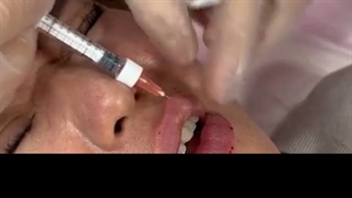 تزریق ژل لب روسی