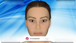 ⚜ روند جراحی کانتوپلاستی