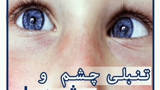 تنبلی چشم