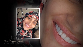 اصلاح طرح لبخند