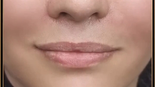 فیلر خط خنده رفع غبغب