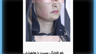 هایفوتراپی پیلینگ