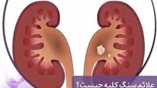 سنگ کلیه