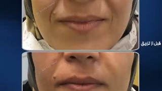 تزریق فیلر خط خنده