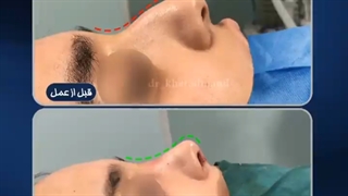 جراحی زیبایی بینی