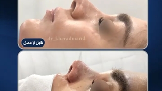 بلافاصله بعد از جراحی زیبایی بینی