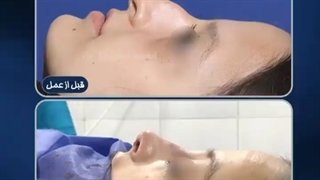 بلافاصله بعد از جراحی بینی طبیعی