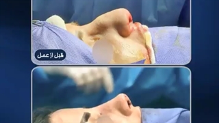 بلافاصله بعد از جراحی زیبایی بینی