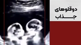 سونوگرافی دوقلوهای جذاب