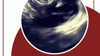 سونوگرافی ترانس واژینال