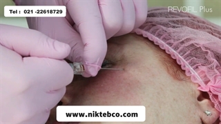 تزریق ژل رووفیل پلاس با کنولا