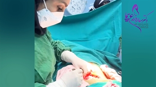 زایمان سزارین قسمت 1
