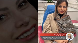 لمینت دندان در مطب دکتر ارشد