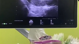 صدای ضربان قلب دوقلوها