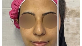 رینوپلاستی+قبل و بعد از عمل