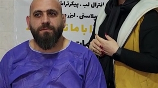 قبل از کاست مو کلینیک آرتان