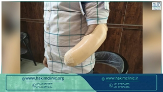 پروتز زیبایی دست-پروتزیست موسوی