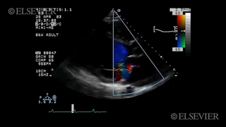 17. Anteroseptal ventricular septal defect