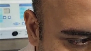 کاشت مو طبیعی