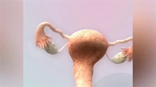 سندروم تخمدان پلی کیستیک