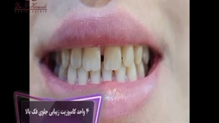 4 واحد کامپوزیت دندان فک بالا