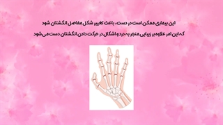 روماتیسم مفصلی یا آرتریت روماتوئید