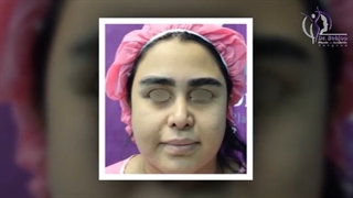 لیفت اندوسکوپی ابرو و شقیقه،رینوپلاستی ترمیمی،تخلیه بوکال فت و چربی غبغب