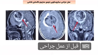 عمل جراحی میکروسکوپی تومور مننژیوم فالساین قدامی