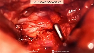 عمل جراحی میکروسکوپی دیسک کمر